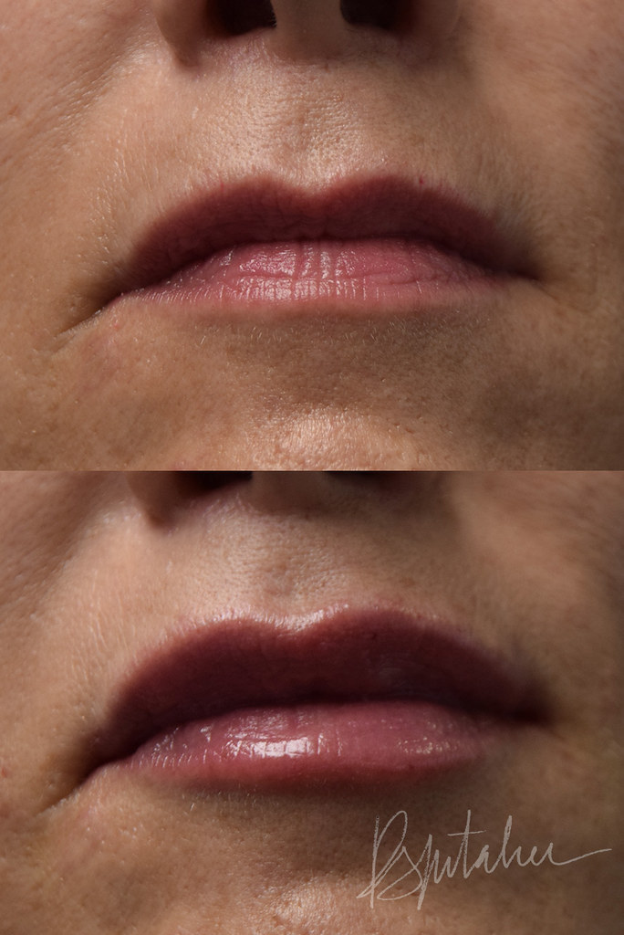 Esthétique des lèvres : injections et volume des lèvres