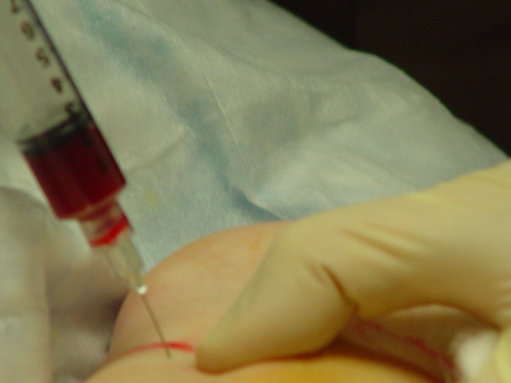 PRP – Plasma riche en plaquettes en médecine esthétique et capillaire